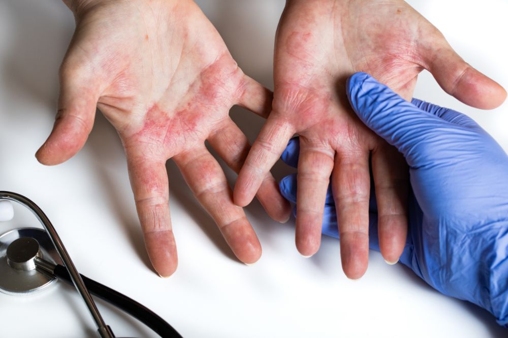 Examen médico de manos con dermatitis por estrés