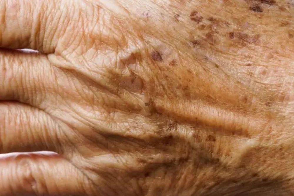 Detalle de manos con manchas y signos de envejecimiento cutáneo