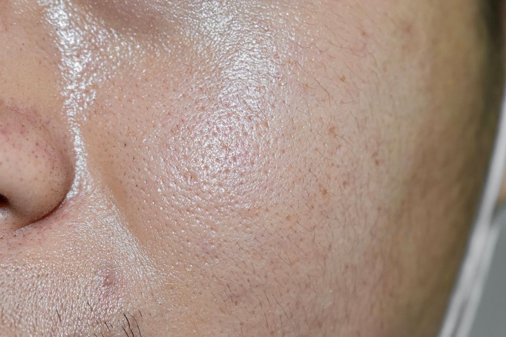 Aplicación de tratamientos dermatológicos avanzados para los poros