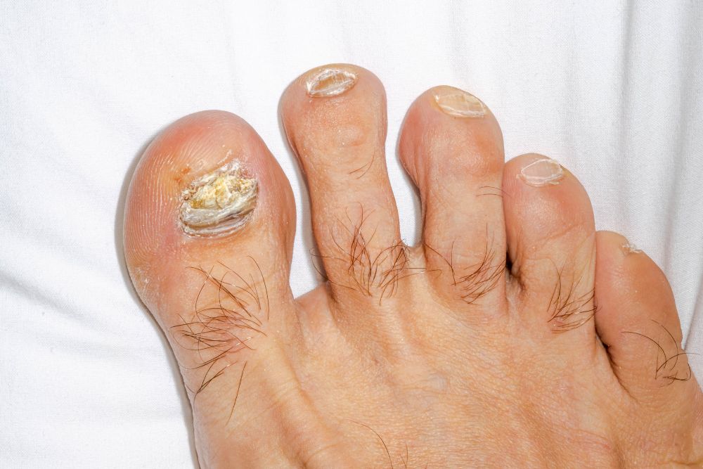 Uñas con signos de hongos u onicomicosis en consulta dermatológica.