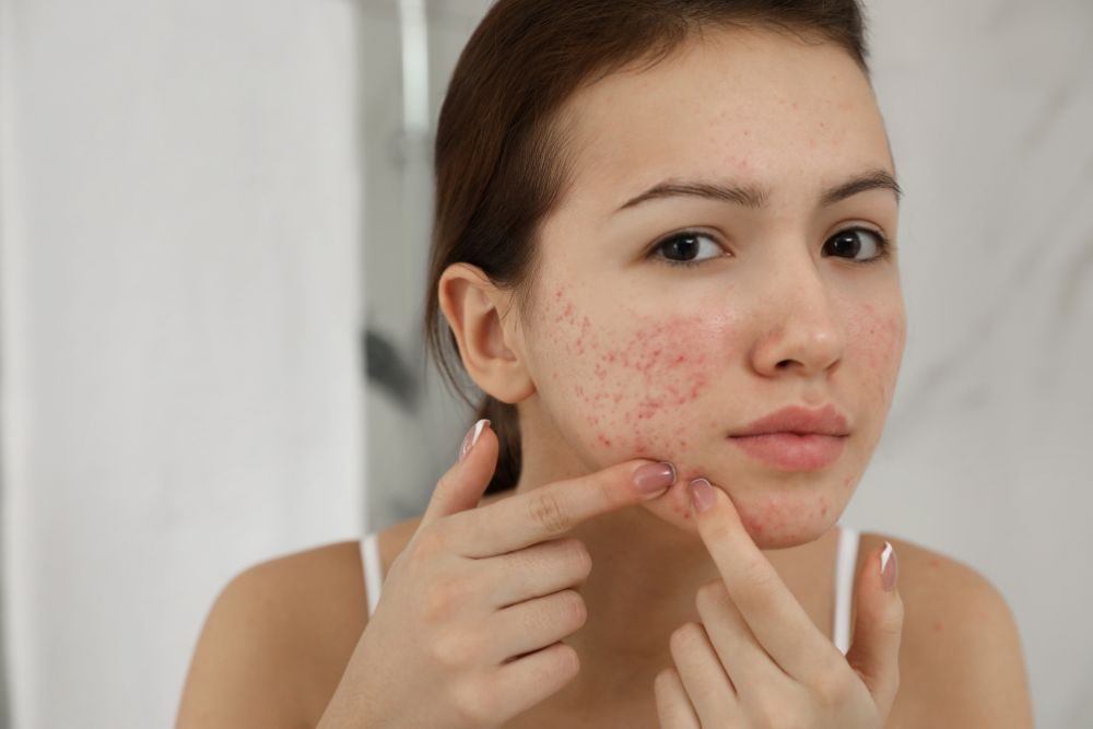 Mujer joven con brote visible de acné adulto en el rostro frente al espejo
