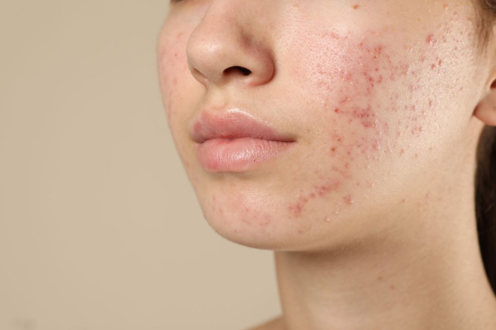 Primer plano de piel facial con marcas y lesiones inflamatorias por acné adulto