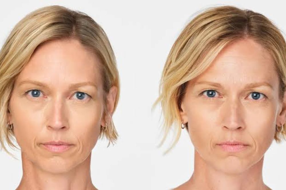 Comparativa de antes y despues del tratamiento con bioestimuladores de colageno en el rostro