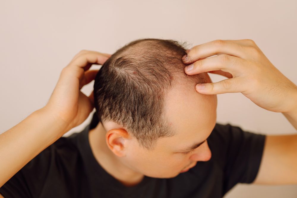 Hombre adulto observando su cabello preocupado por la alopecia androgenética antes de iniciar un tratamiento.