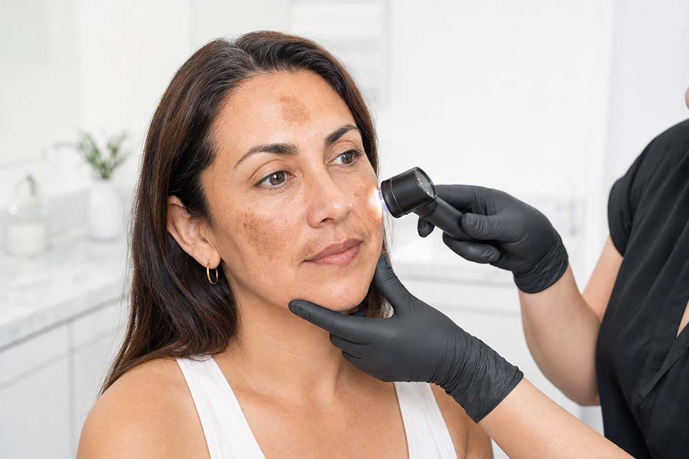 Melasma: causas reales, tratamientos efectivos y errores que lo empeoran